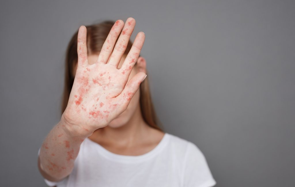 Największa epidemia odry na świecie. Ponad 167 tys. podejrzanych przypadków i ponad 1000 zgonów