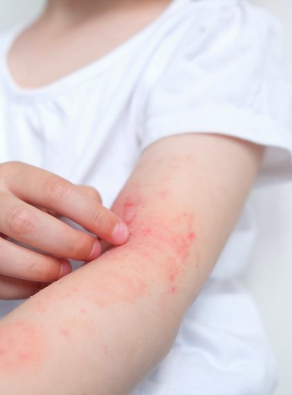 Świąd i zmiany skórne? Atopowe zapalenie skóry (AZS)