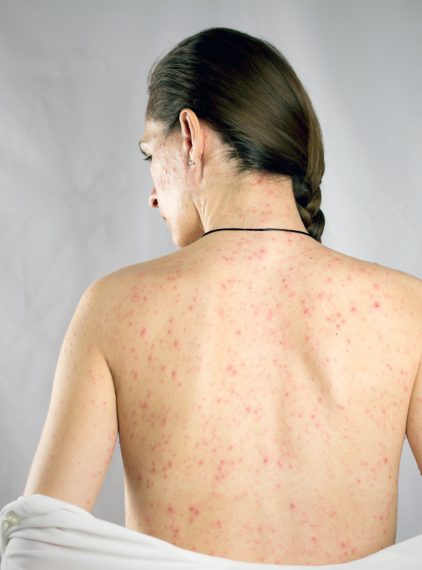 Różyczka. Jak wyglądają objawy?