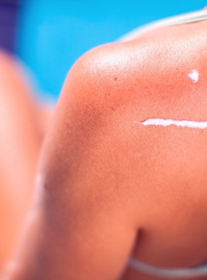 Przebywasz często na słońcu? Uważaj na znamiona! Słowo o czerniaku