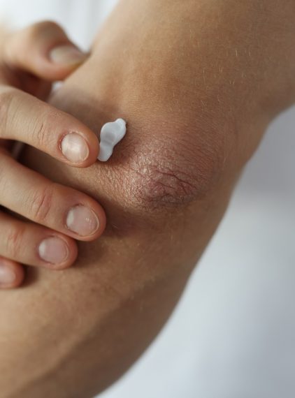 Łuszczyca. Jak ją leczyć? Jakie kosmetyki wybrać?