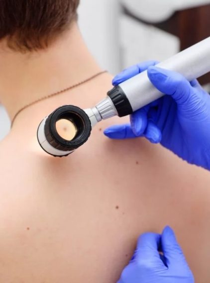 Jak leczyć brodawczaka?