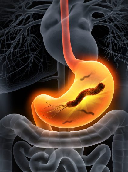 Helicobacter pylori. Częsta przyczyna problemów z żołądkiem