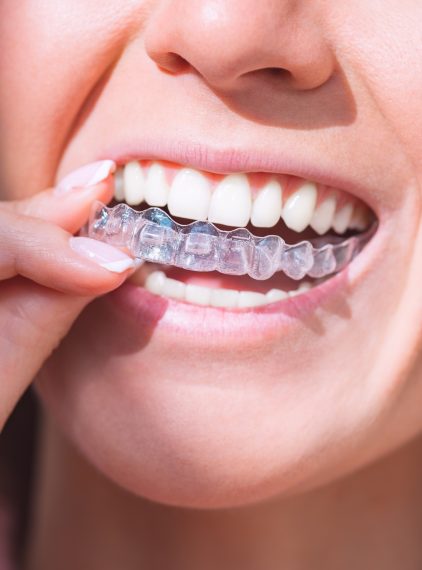 Higiena aparatu ortodontycznego. Jak o nią dbać?