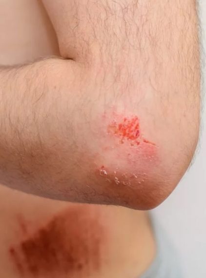 Gojenie ran a cukrzyca