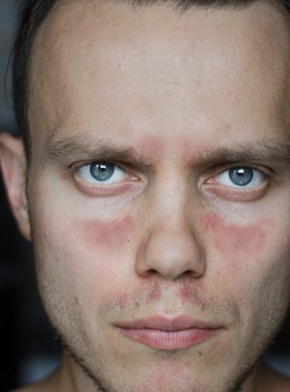 Toczeń. Jak się objawia?