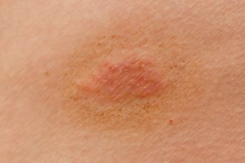 Jak leczyć grzybicę skóry w cukrzycy?