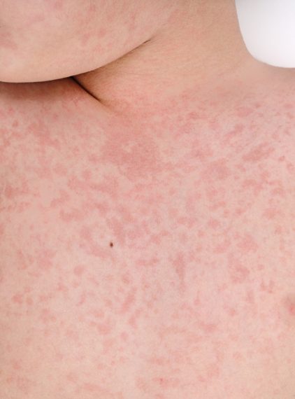 Odra – przyczyny, objawy, leczenie