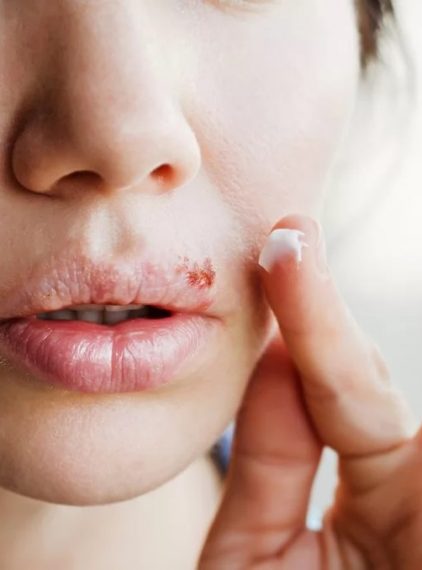 Opryszczka wargowa w ciąży. Jak ją leczyć?