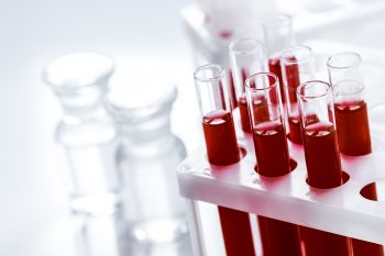 Zespół antyfosfolipidowy – objawy i sposoby leczenia