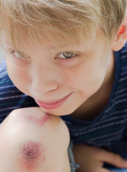 Naturalne sposoby na siniaki