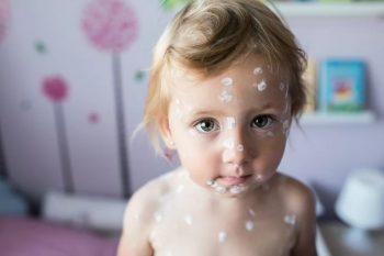 Dlaczego ospa party jest niebezpieczne?