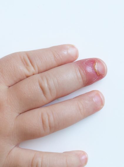 Zastrzał i zanokcica – rodzaje i sposoby leczenia