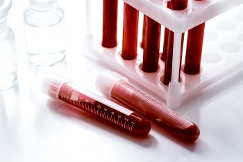 Zwiększony poziom erytrocytów – jakie są przyczyny?