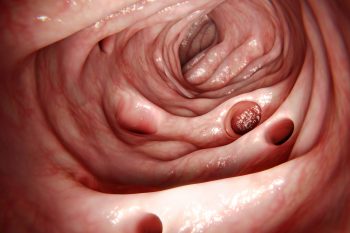 Uchyłkowatość jelita grubego