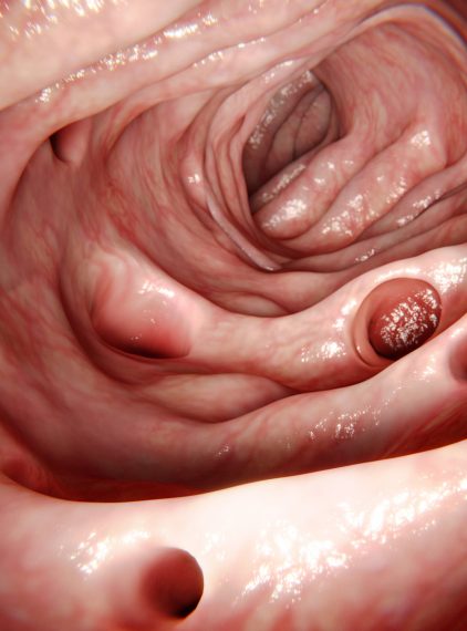 Uchyłkowatość jelita grubego