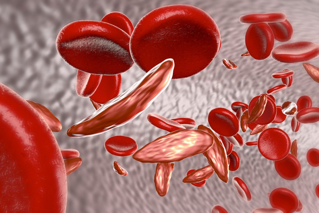 Choroby związane z nieprawidłową budową hemoglobiny