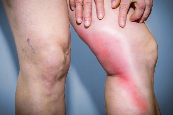 Zakrzepica żył – przyczyny, objawy, leczenie