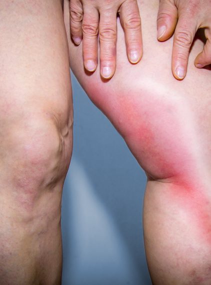 Zakrzepica żył – przyczyny, objawy, leczenie