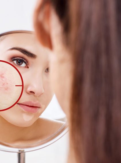 Jak przygotować cerę trądzikową pod makijaż?