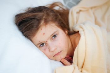 Ospa wietrzna. Atakuje nie tylko dzieci!