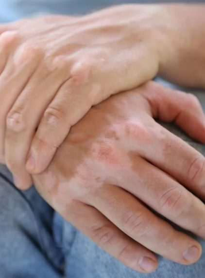 Czy bielactwo jest zaraźliwe?