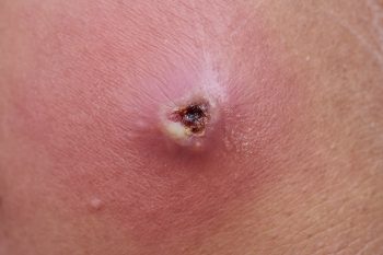 Ropień – przyczyny, objawy, leczenie