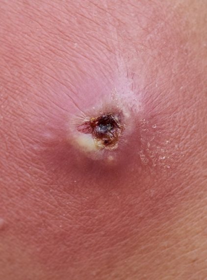 Ropień – przyczyny, objawy, leczenie