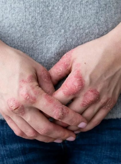 Czy łuszczyca jest zaraźliwa?