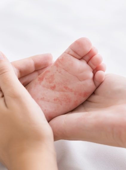 Bostonka (choroba bostońska). Co to jest, jak zaraża i jak długo trwa?