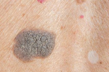 Brodawki łojotokowe – czy mogą świadczyć o chorobie?