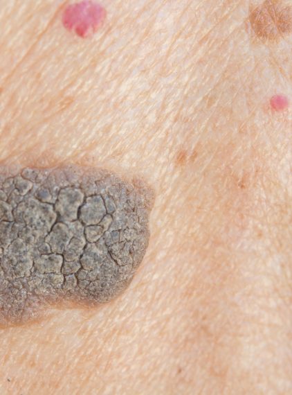 Brodawki łojotokowe – czy mogą świadczyć o chorobie?