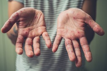 Epidemia odry na Samoa