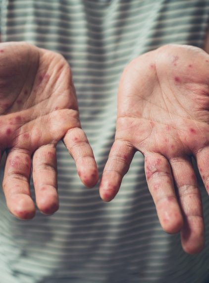 Epidemia odry na Samoa