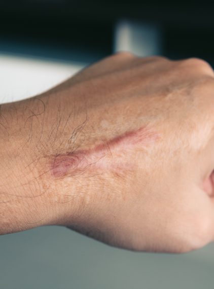 Co to jest bliznowiec?