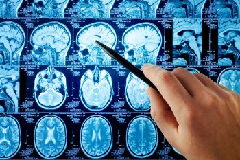 Rezonans magnetyczny głowy – co wykrywa?