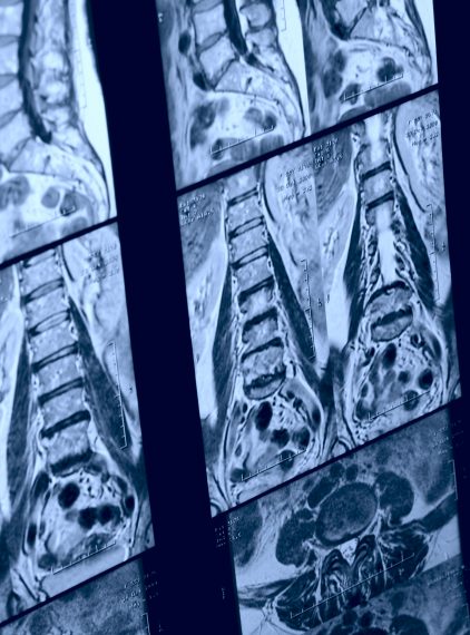 Rezonans magnetyczny kręgosłupa – kiedy się go wykonuje?