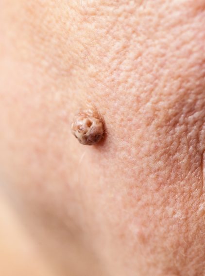 Włókniak. Kiedy trzeba go usunąć?