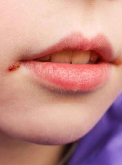 Sposoby na zajady u dziecka