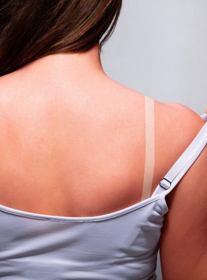 Jak złagodzić oparzenia słoneczne?