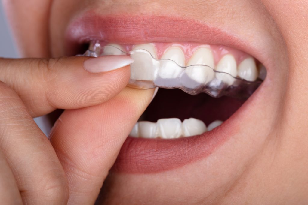 Nakładka na zęby Clear Aligner