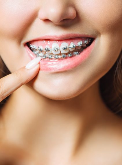 Jakie są rodzaje aparatów ortodontycznych?