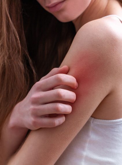 O jakich chorobach może świadczyć świąd skóry?