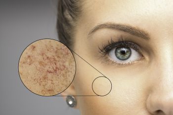 Jak dbać o cerę naczynkową?