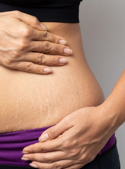 Rozejście mięśnia prostego brzucha – jak je zniwelować?