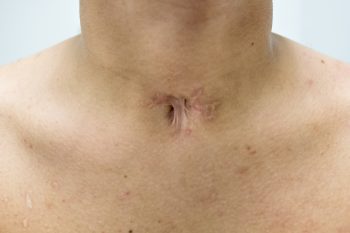 Mowa osób po usunięciu krtani