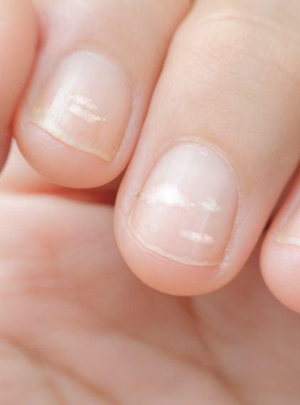 Co oznaczają białe plamy na paznokciach?