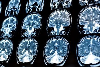 Wodogłowie – przyczyny, objawy, leczenie