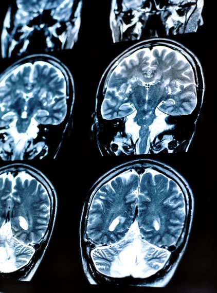 Wodogłowie – przyczyny, objawy, leczenie