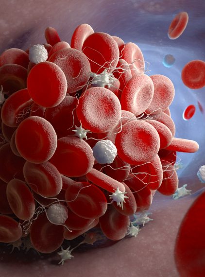 Profilaktyka zakrzepicy – czy dieta uchroni nas przed chorobą?